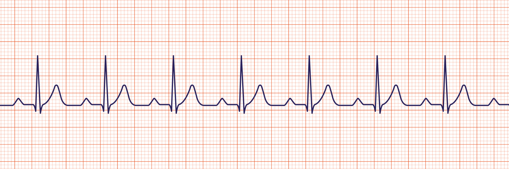 acls ecg rhythms