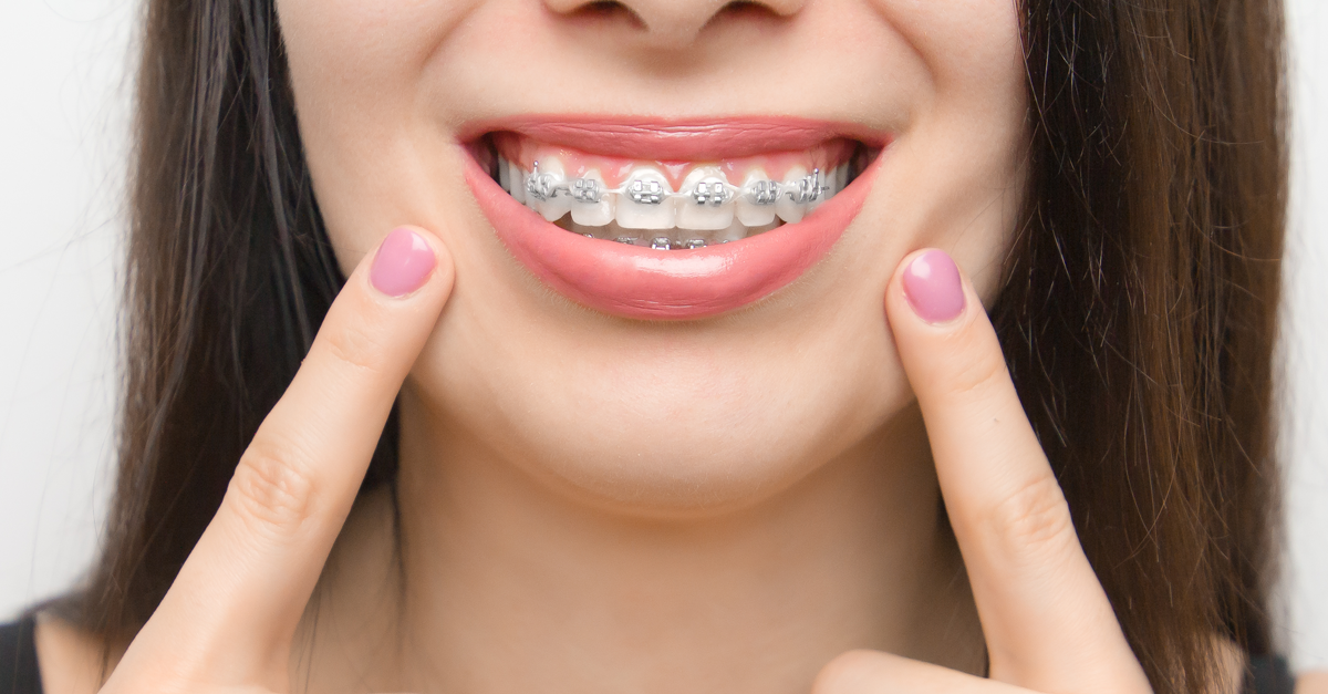 imagenes de brackets bonitos