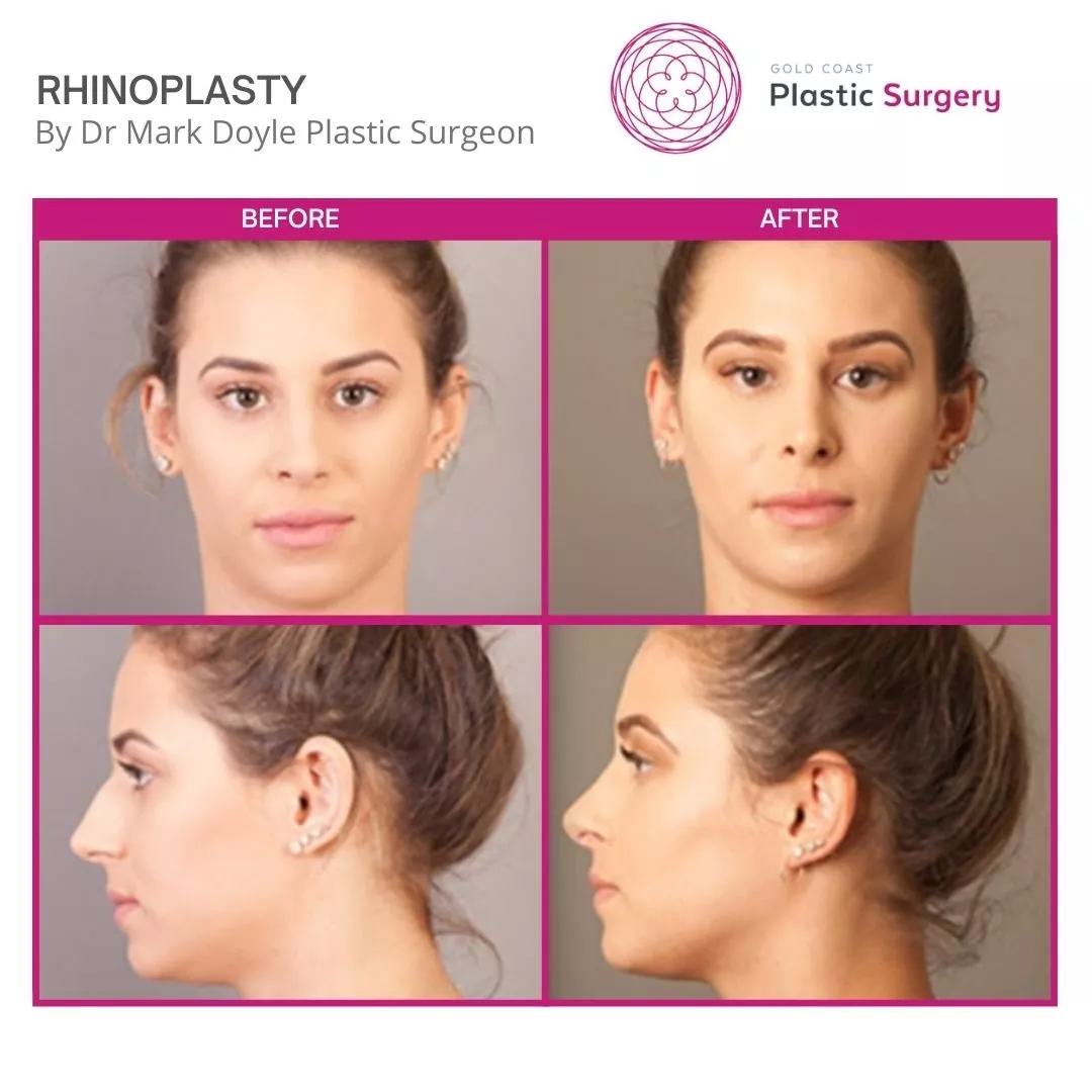 cheap rhinoplasty australia