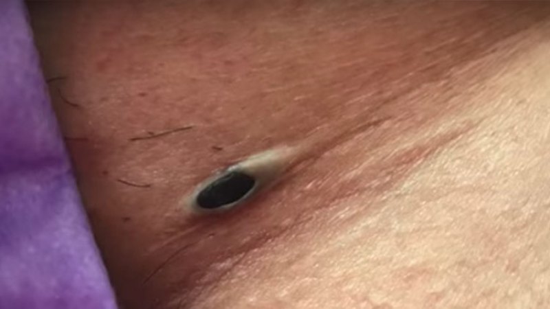 dr pimple popper biggest blackhead