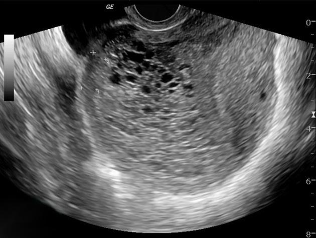 molar pregnancy radiology