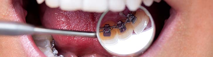 how much do braces cost in kansas city