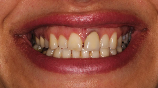 teeth veneers consultation richmond bc