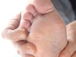 athletes foot meaning in tamil