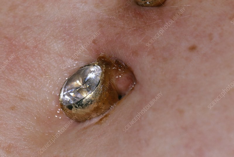 belly button ring infection