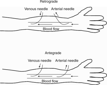 flipping the arterial vascular access needle