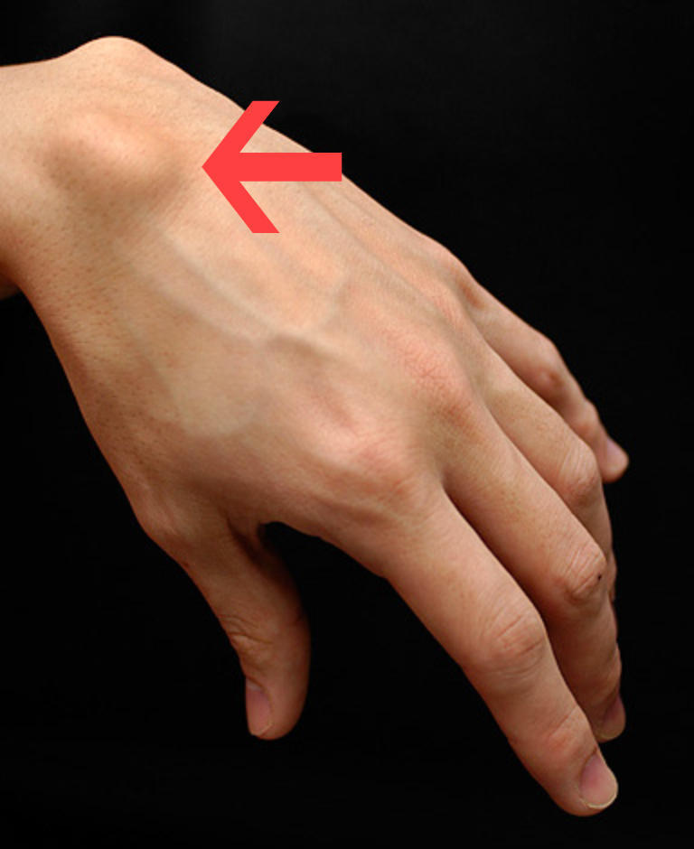 ganglion cyst icd 10