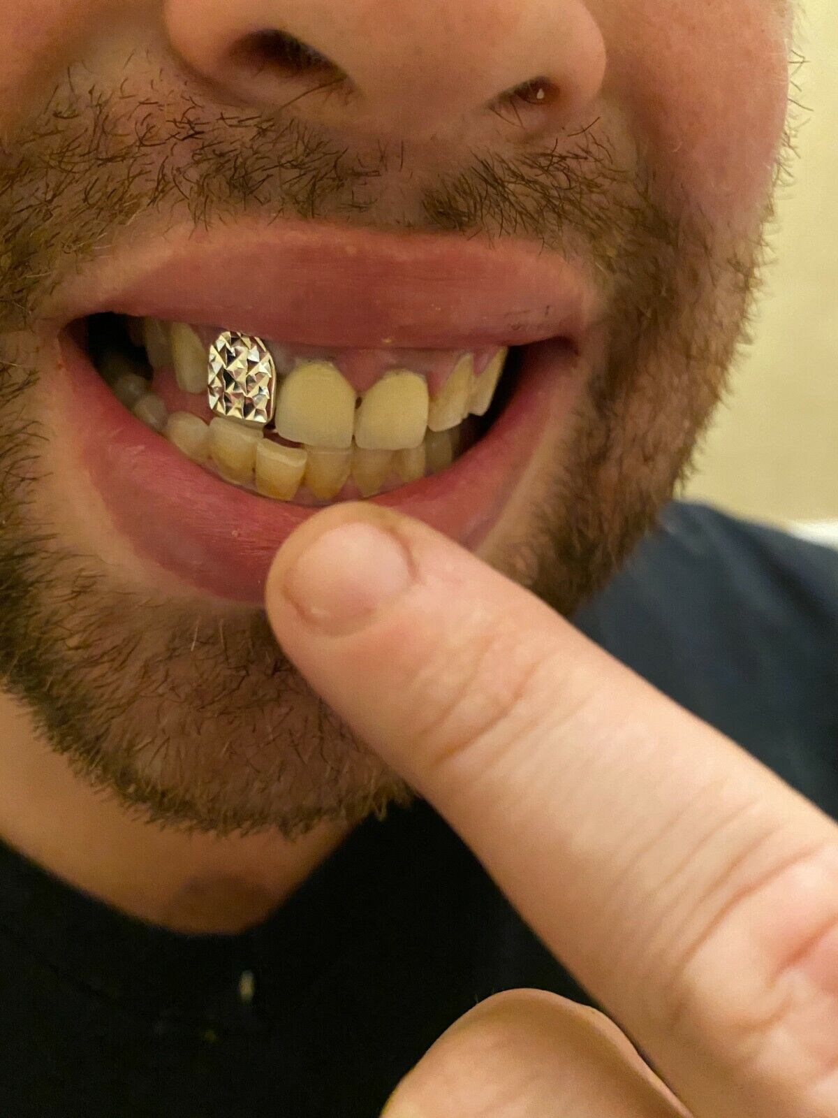 single tooth grill