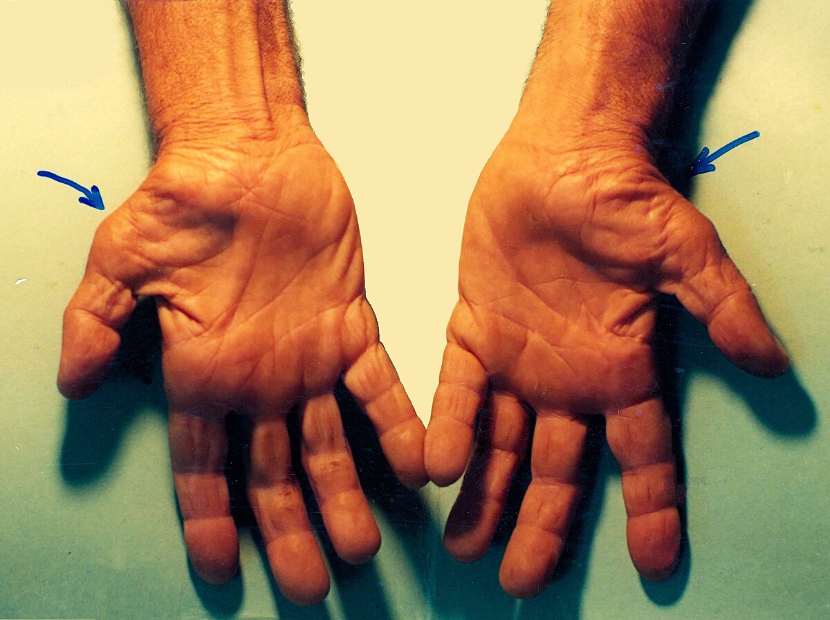carpal tunnel syndrome wiki