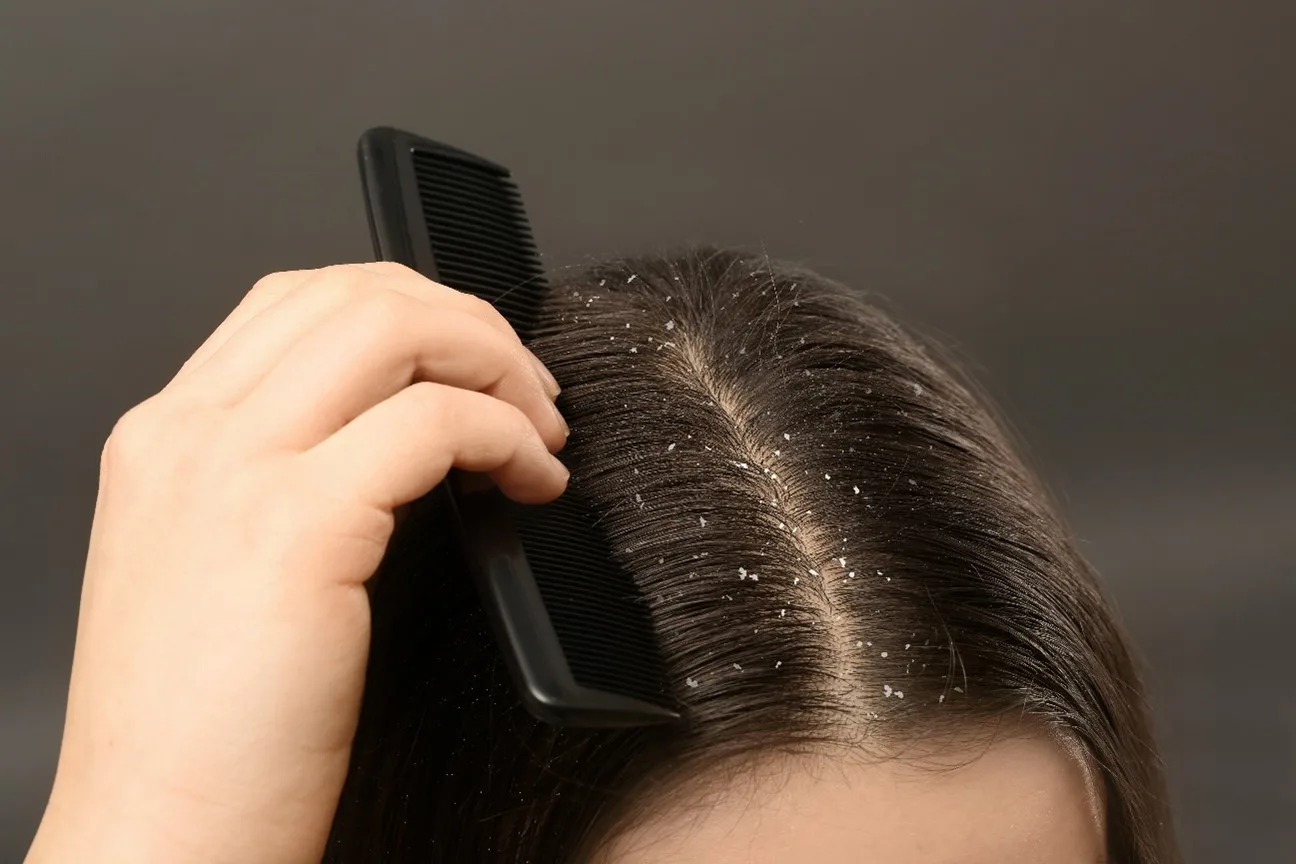 lice comb for dandruff