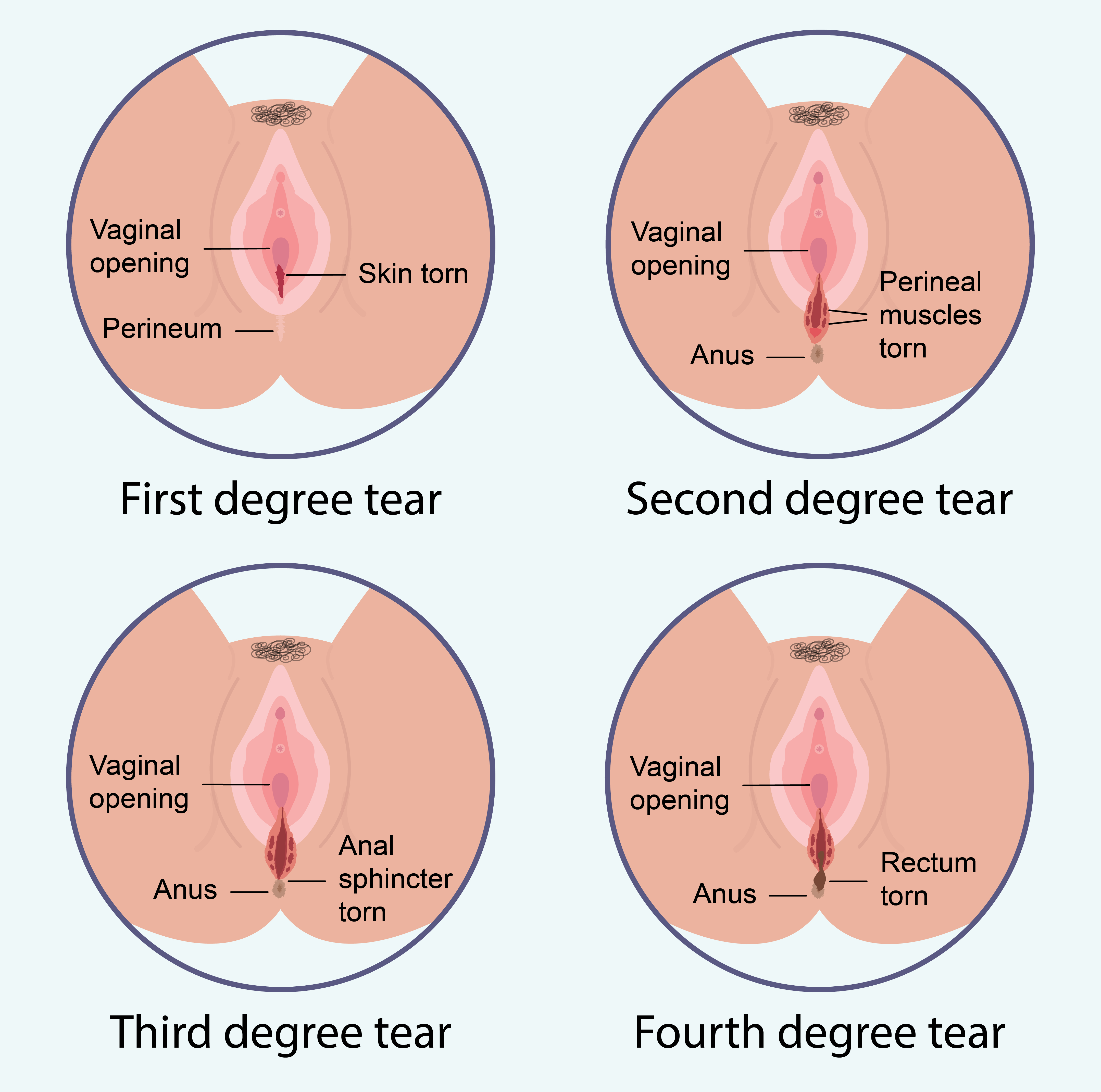 3rd degree perineal tear pictures