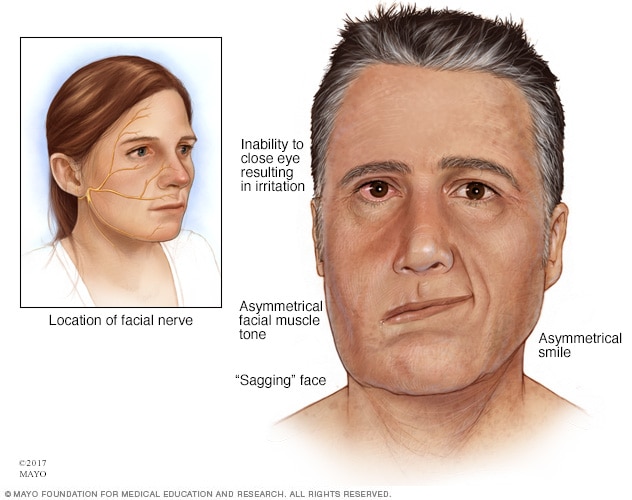 facial weakness icd 10