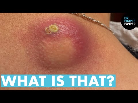 popping zits on youtube