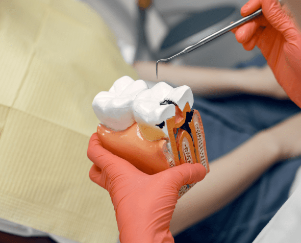 dental root canals services maple ridge