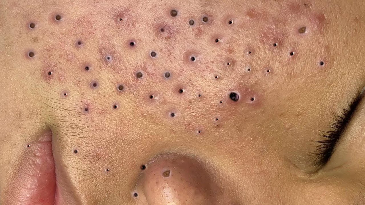 blackheads youtube