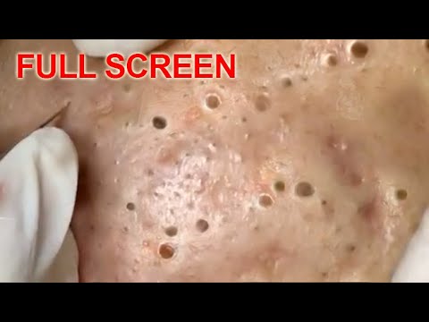 youtube zit popping