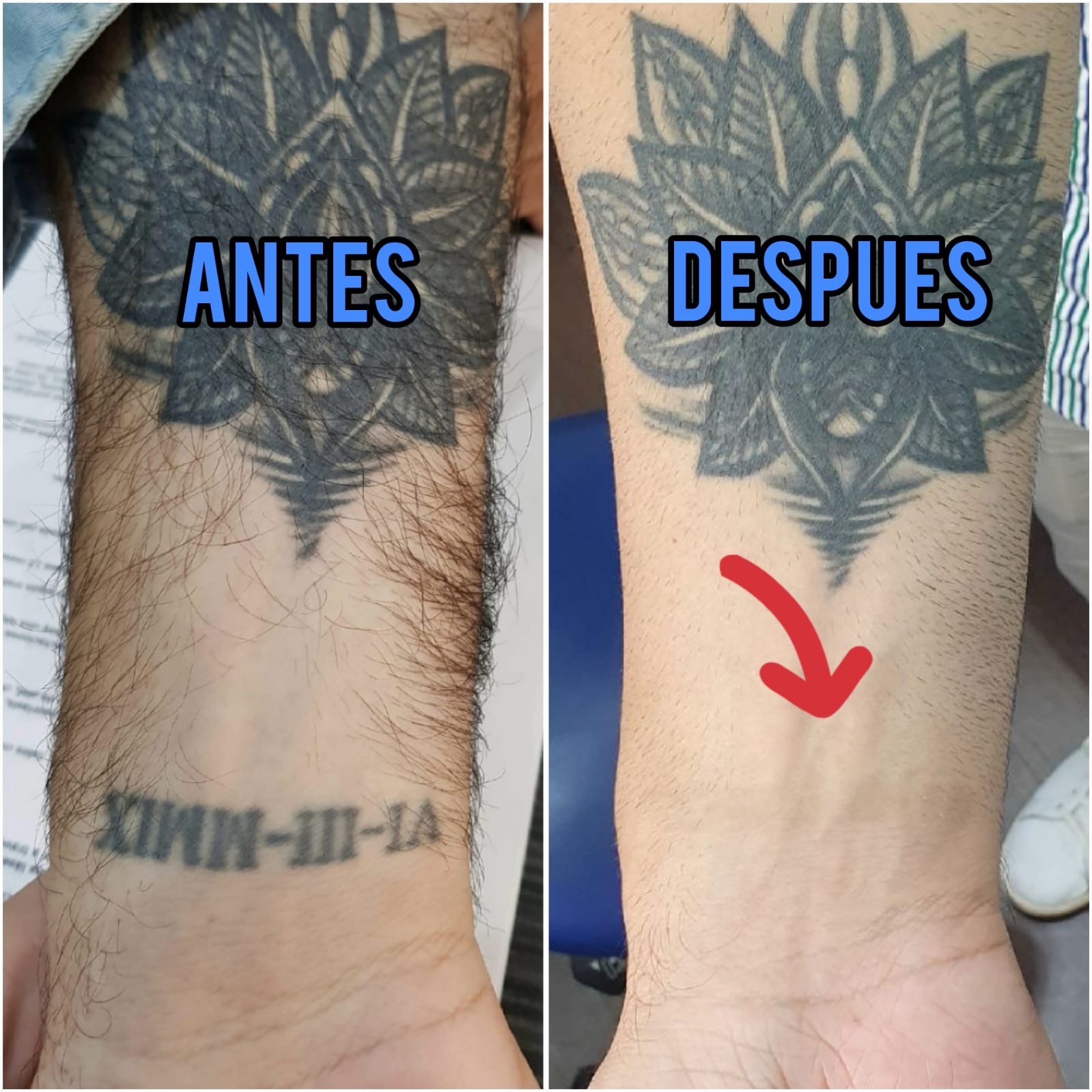 tattoo removal madrid