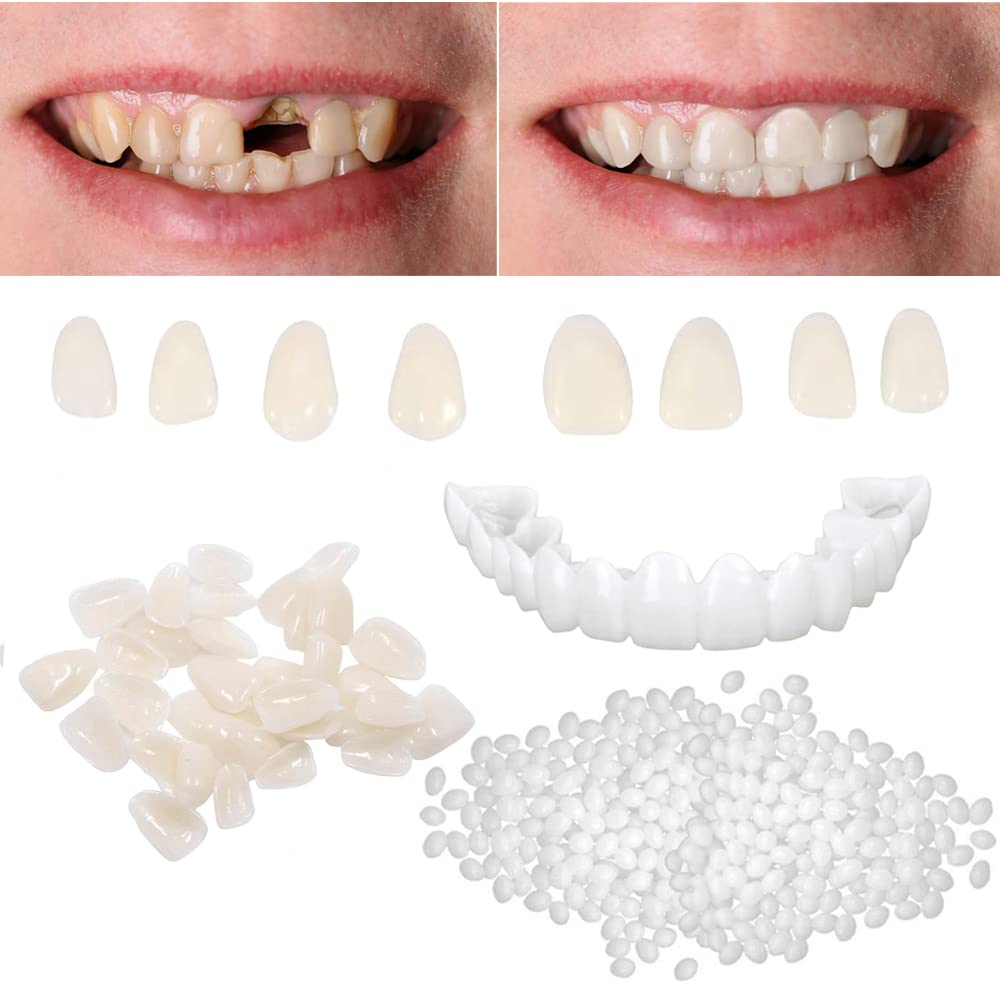 cracked tooth repair kit