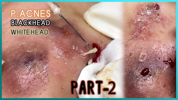 popping cystic acne