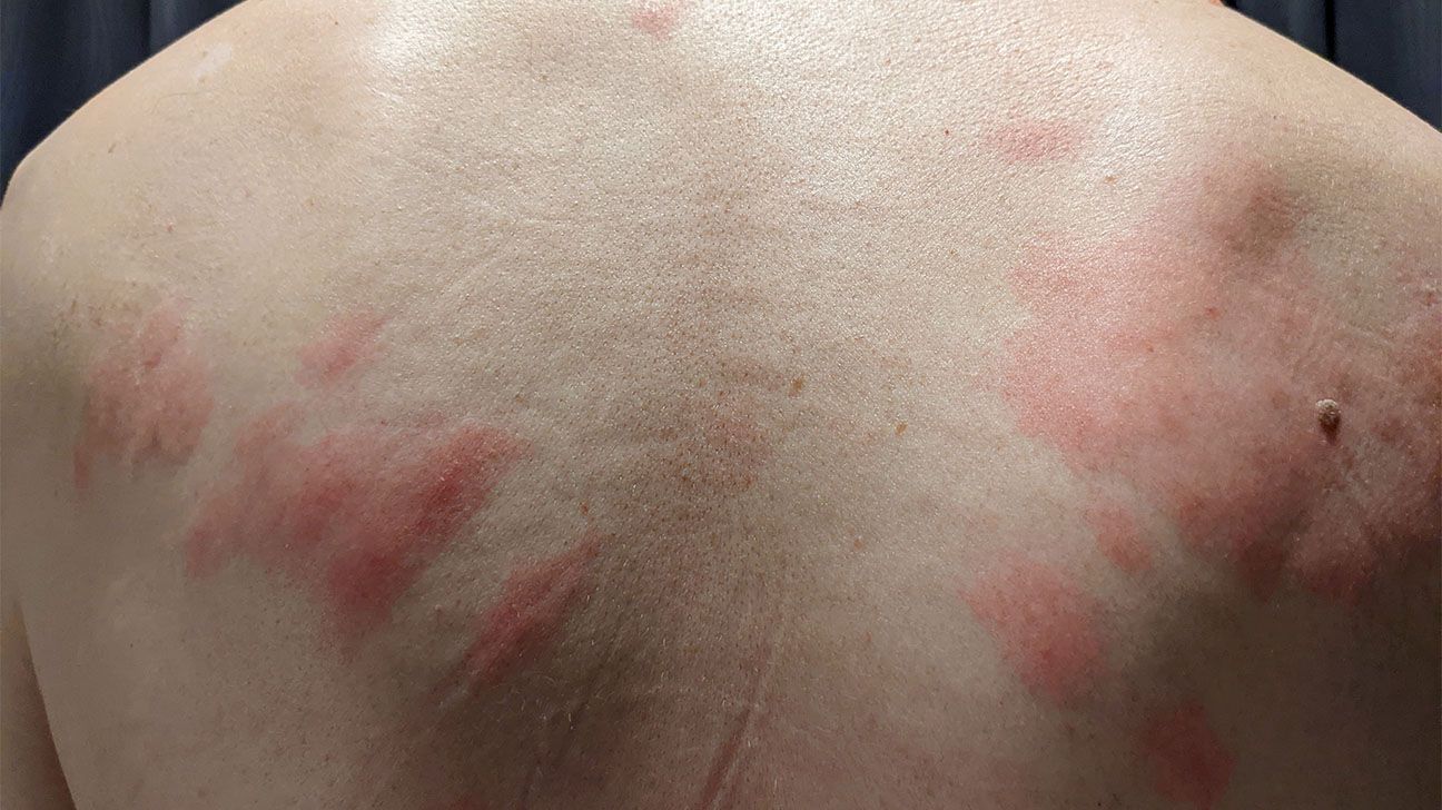 sea lice rash pics