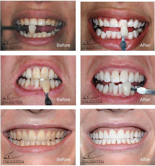 polanight teeth whitening reviews