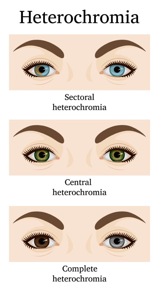 central heterochromia rarity