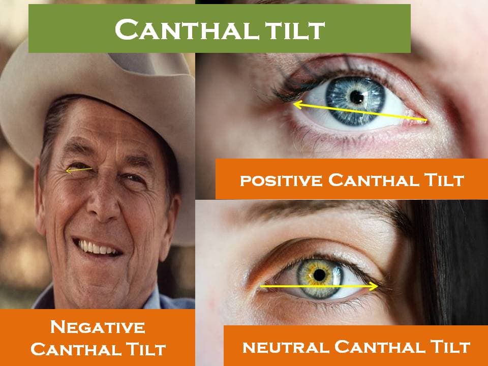 neutral canthal tilt