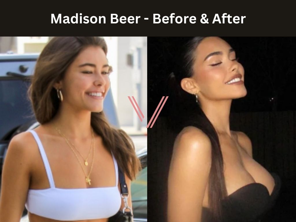 madison beer boob job