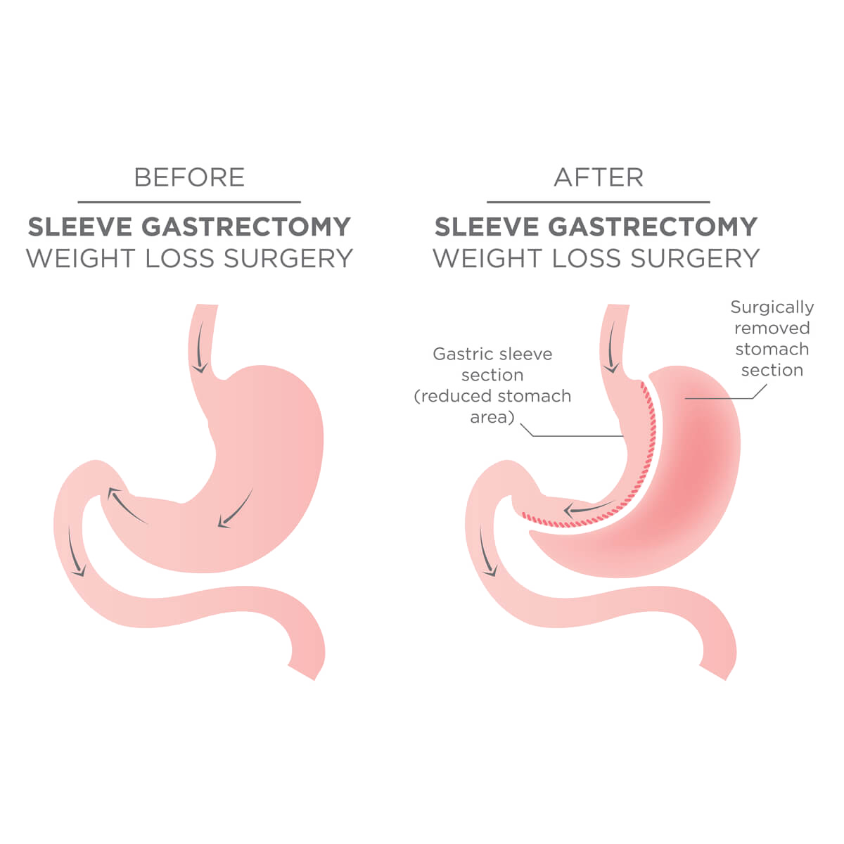 gastric sleeve surgery perth