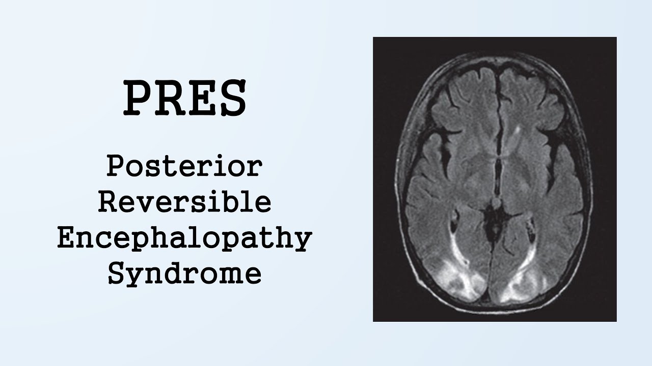 posterior reversible encephalopathy