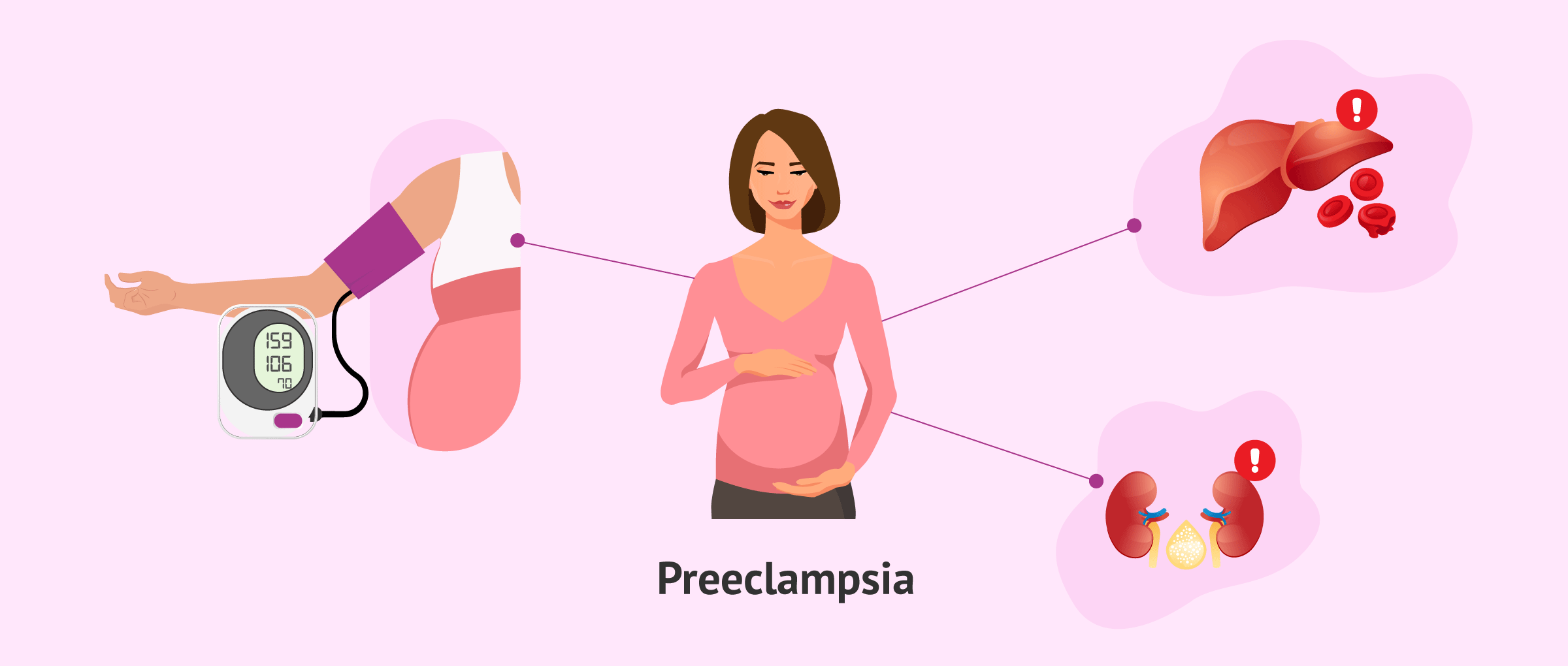 preeclampsia dibujo