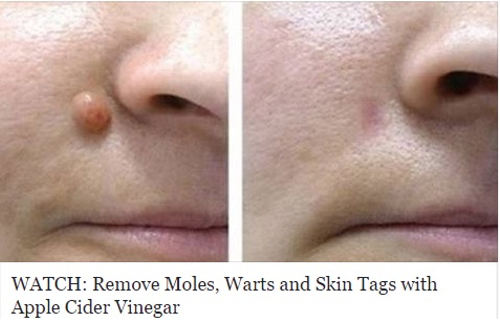 apple cider vinegar for moles