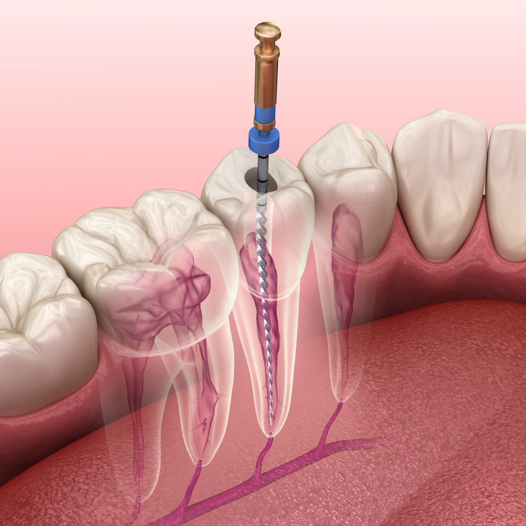 dental root canals treatment maple ridge