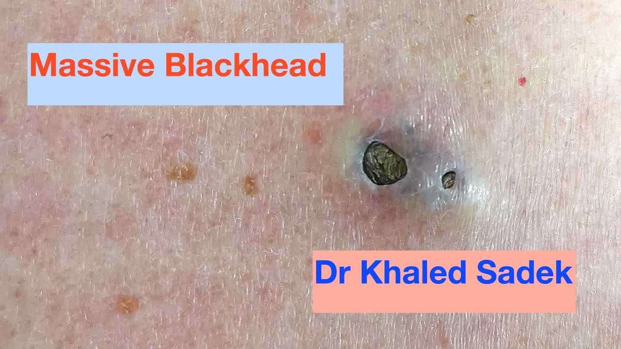 massive blackhead on back