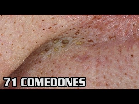 pimple popping videos on youtube