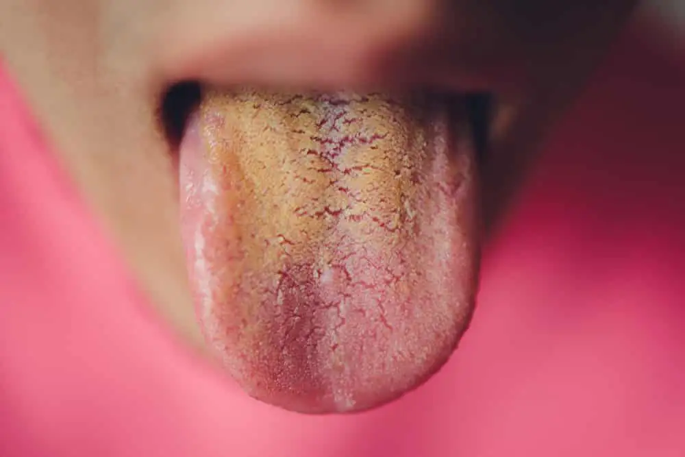 unhealthy tongue pics