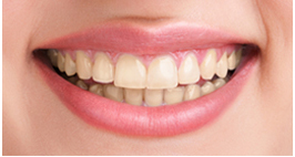 dental bleaching richmond bc