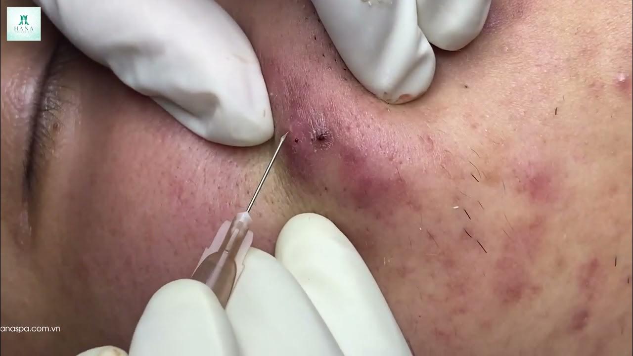 blackhead popping videos 2023