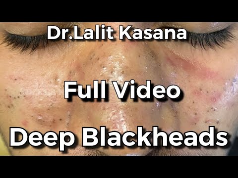 videos of blackhead removal