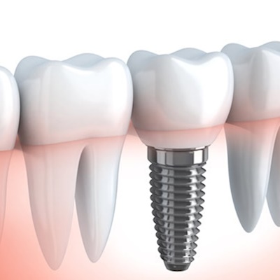 implant fiyatları 2019 izmir