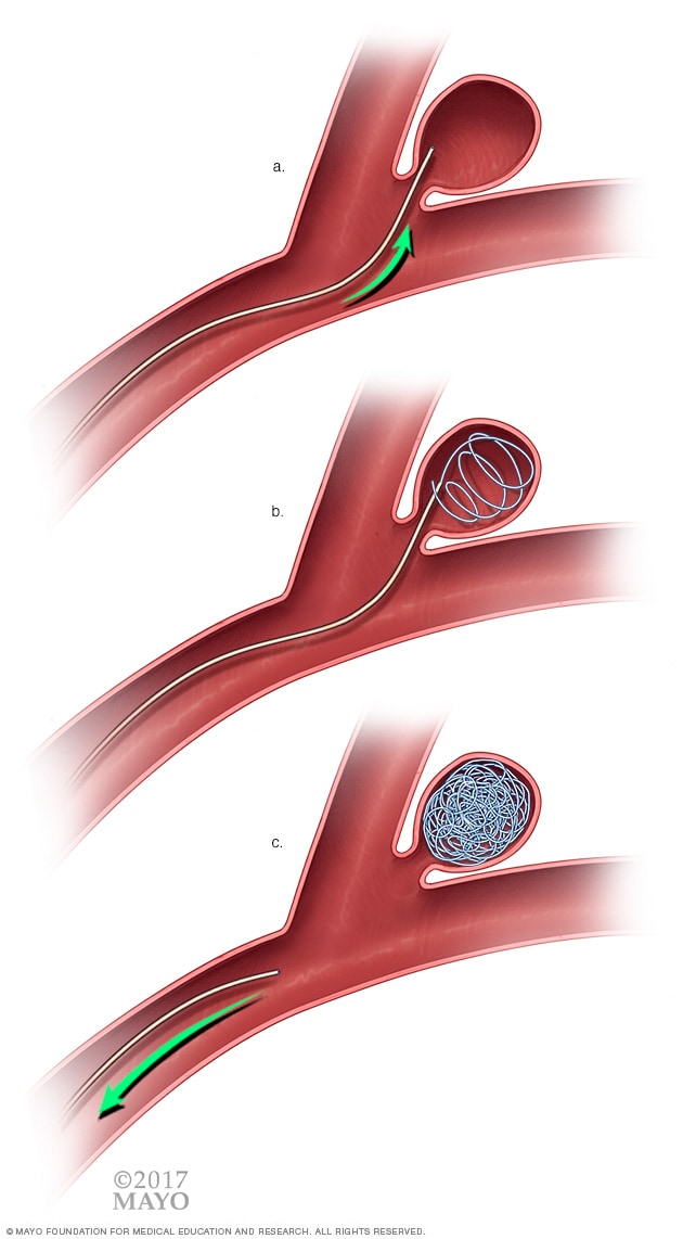 aneurisma mayo clinic