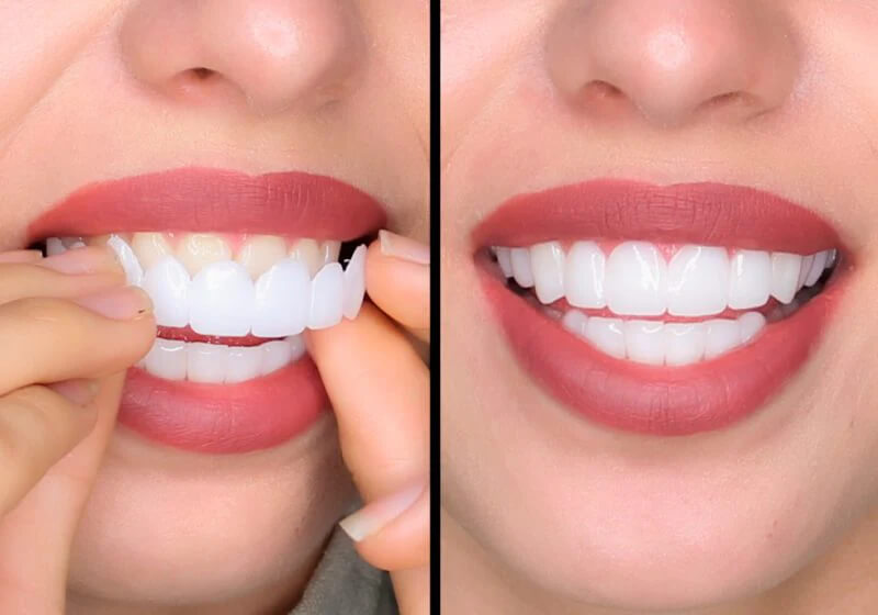 best clip on veneers