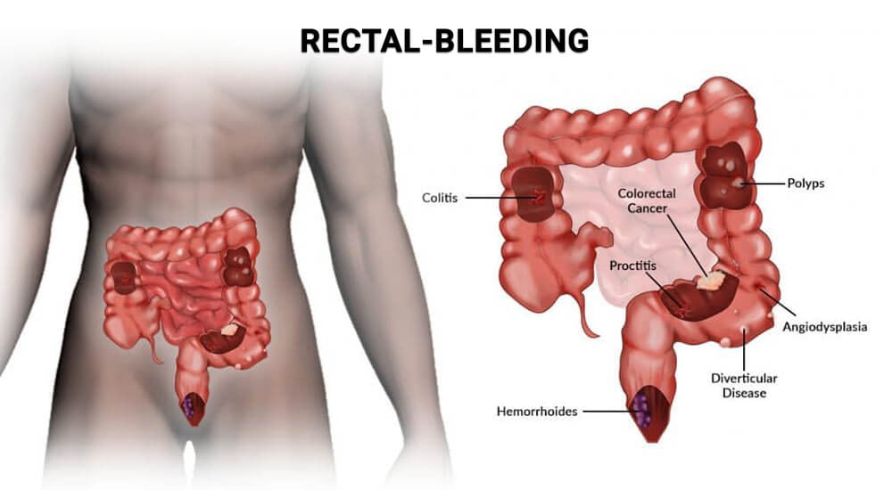 bright red blood per rectum icd 10