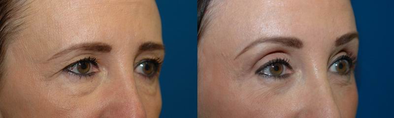 brow lift bellevue wa