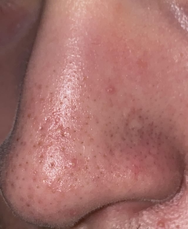 sebaceous filaments permanently stretched nose pore