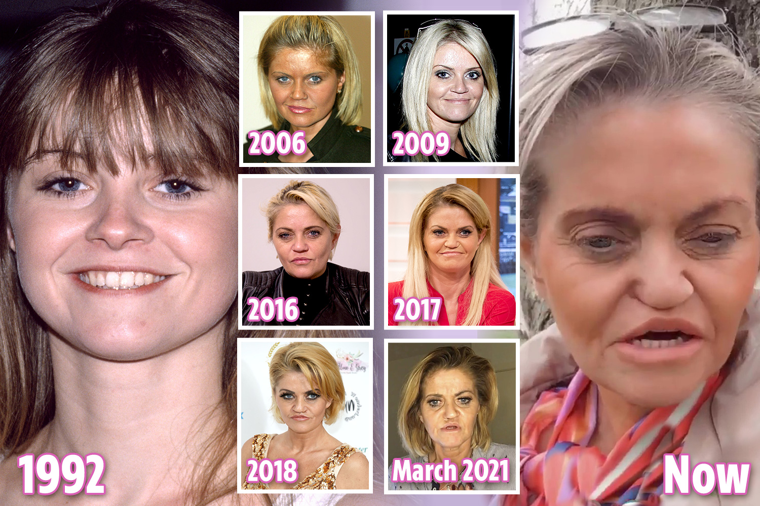 danniella westbrook face surgery