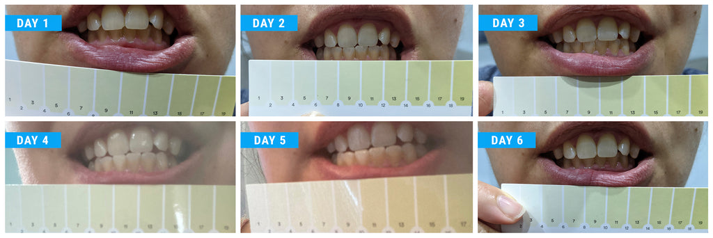 hismile teeth whitening strips reviews