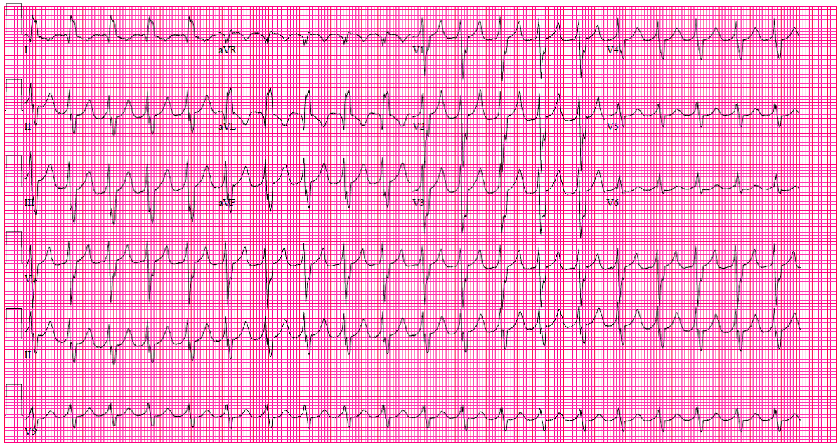 ecg drills