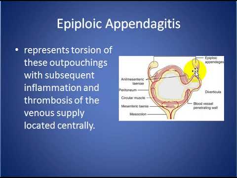 epiploic appendagitis icd 10