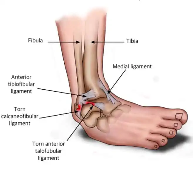 right ankle sprain icd 10
